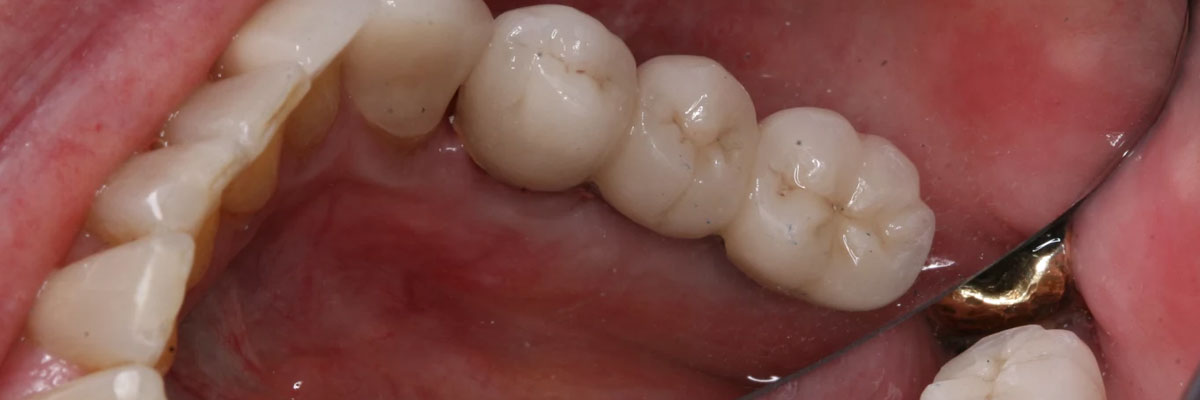 Hollywood All-on-4 Dental Implants