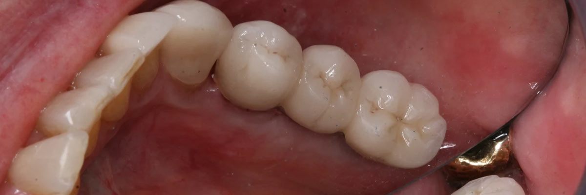 Hollywood Will I Need a Bone Graft for Dental Implants?