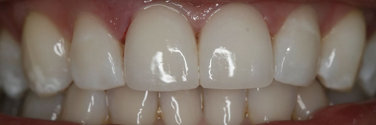 Hollywood What Should I Do If I Chip My Tooth?