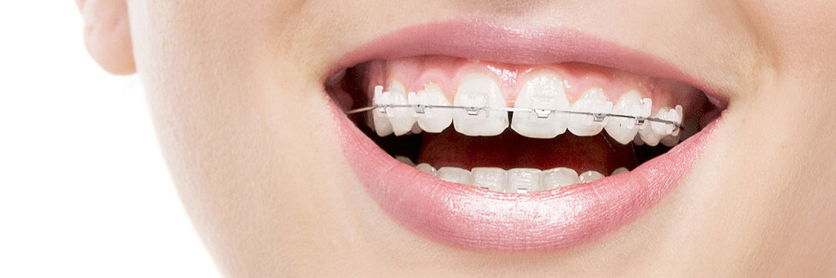 Hollywood Invisible Orthodontics