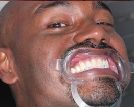 ClearCorrect Braces