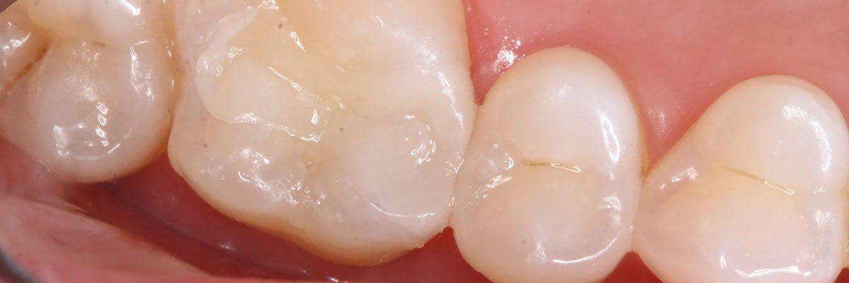 Hollywood Tooth Colored Fillings