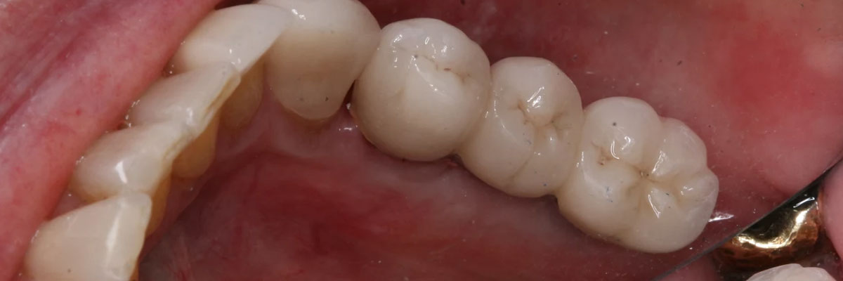 Hollywood The Dental Implant Procedure