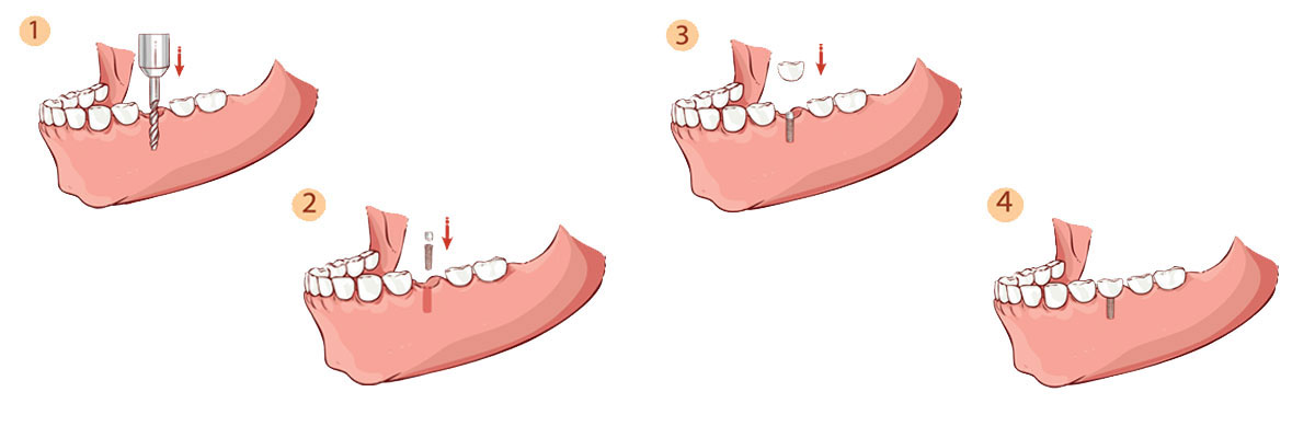 Hollywood Dental Implant Restoration