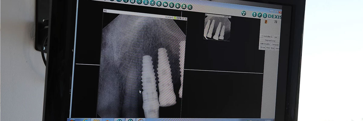 Hollywood Dental Prosthetics