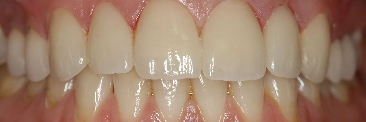 Hollywood Dentures