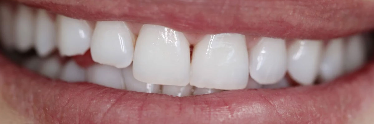 Hollywood Does Invisalign® Really Work?