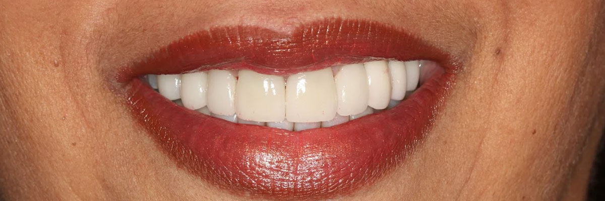 Hollywood Full Mouth Reconstruction