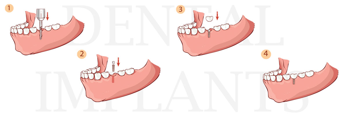 Hollywood The Difference Between Dental Implants and Mini Dental Implants