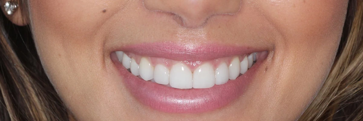 Hollywood Improve Your Smile for Senior Pictures