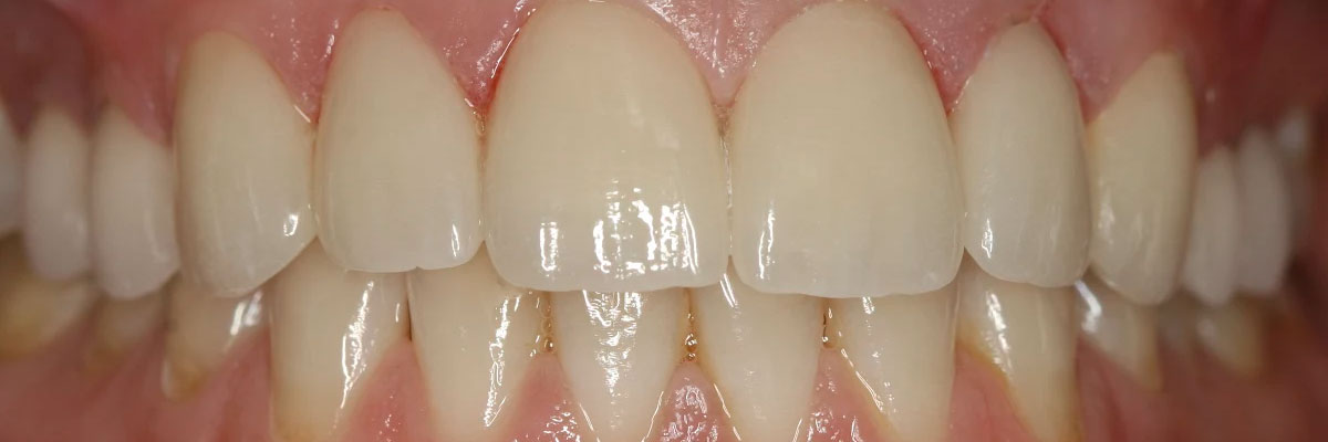 Hollywood Invisalign for Teens