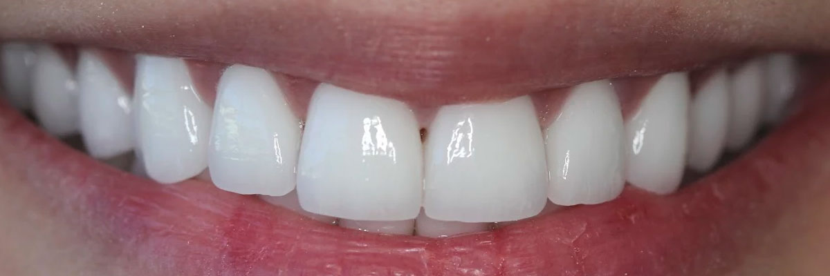 Hollywood Invisalign