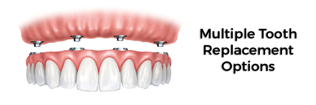 Hollywood Multiple Teeth Replacement Options
