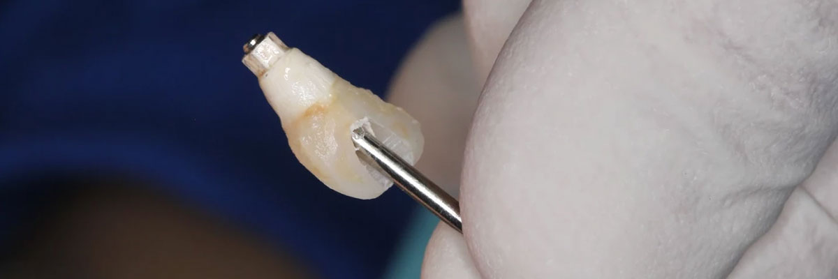 Hollywood Options for Replacing Missing Teeth