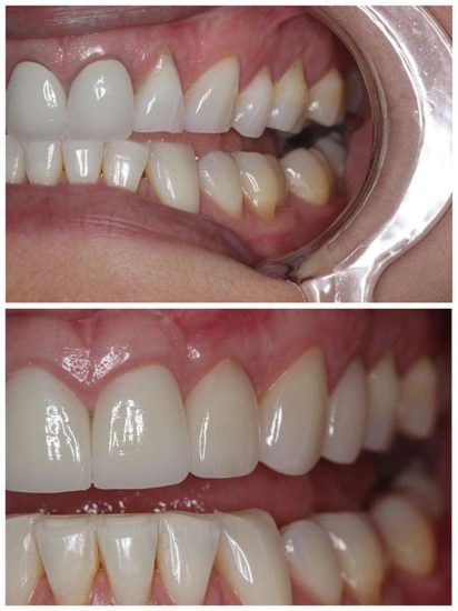 Pinhole Surgeries - Vick Kargodorian, DDS Hollywood California