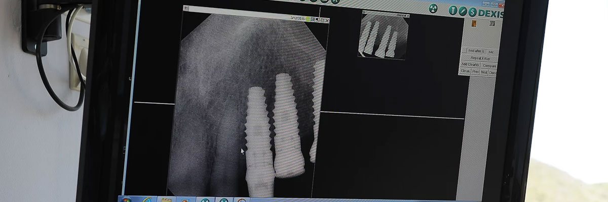 Hollywood Post-Op Care for Dental Implants