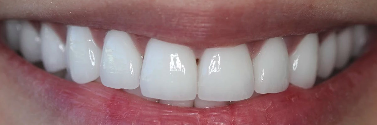 Hollywood Smile Makeover