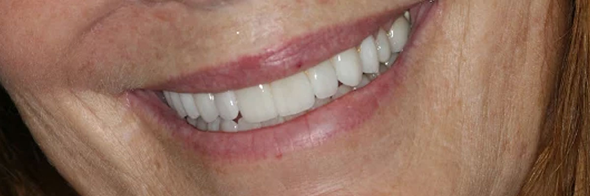 Hollywood Snap-On Smile