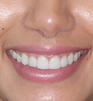 Clear Aligners - Almost Invisible Braces Hollywood, CA