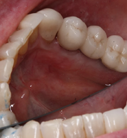 Dental Implant Services Hollywood, CA