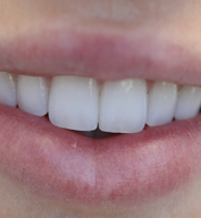 Teeth Whitening Services Hollywood, CA