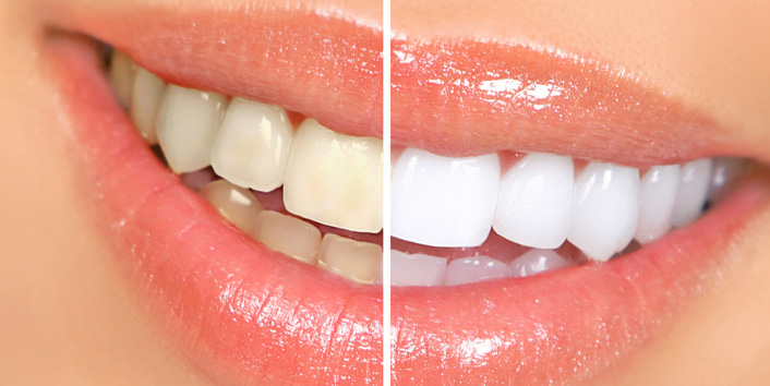 Teeth Whitening Hollywood, CA, Vick Kargodorian, DDS