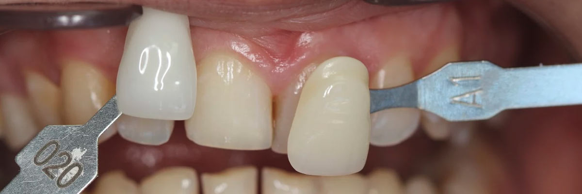 Hollywood Dental Restoration