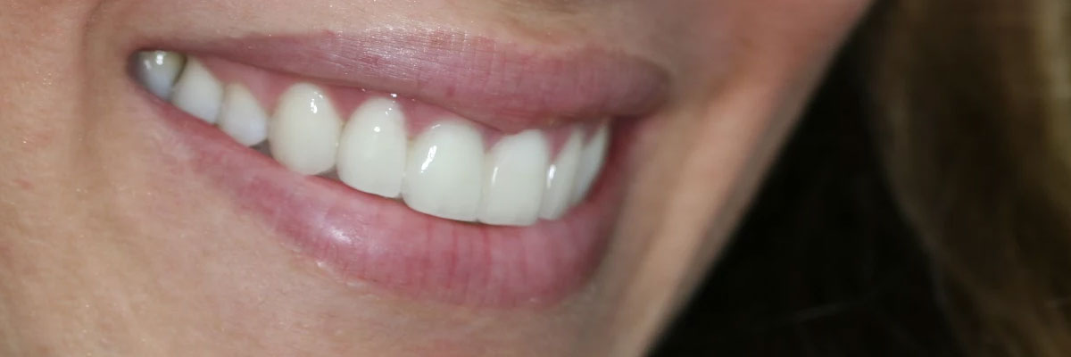 Cost Of Teeth Whitening At Dentist Office - TeethWalls