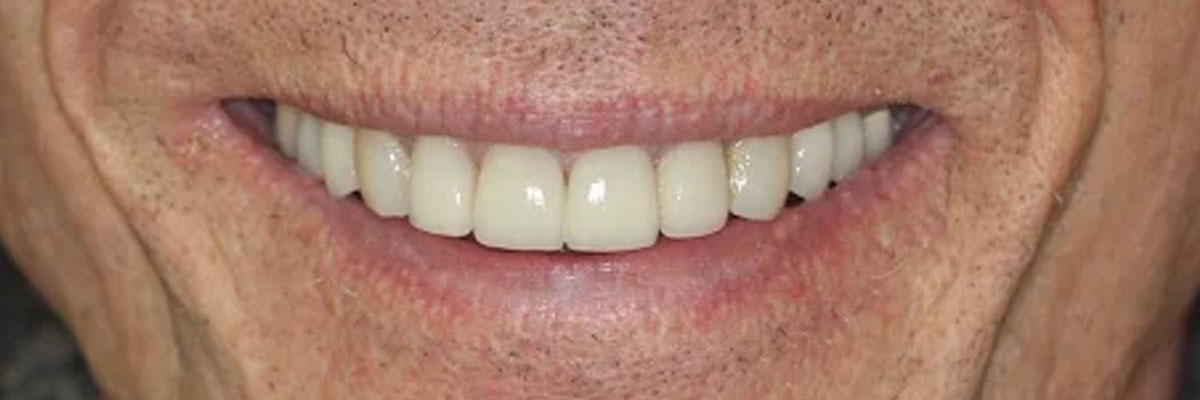 Hollywood TeethXpress