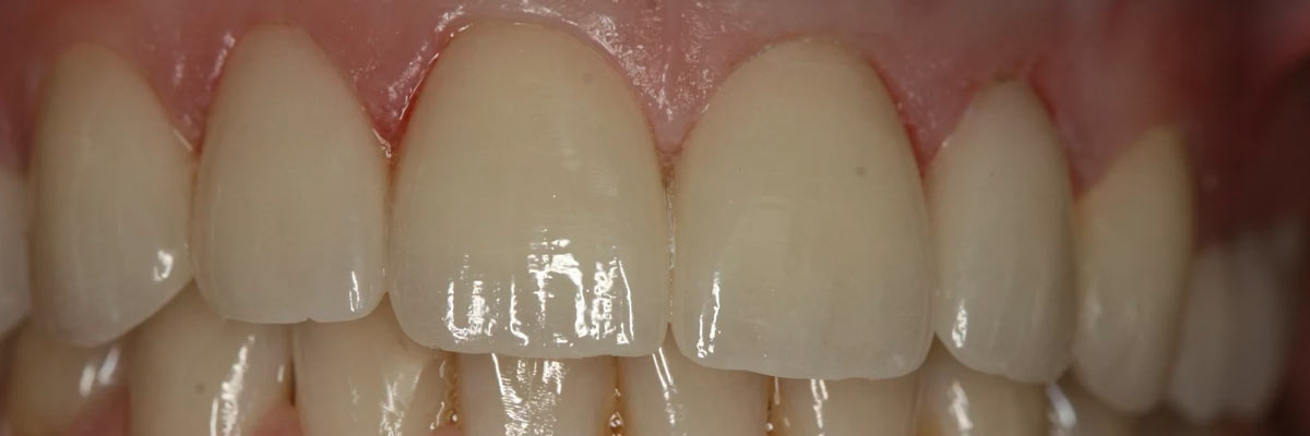 Hollywood Why Are My Gums Bleeding?