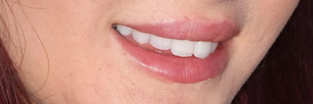 Hollywood Zoom Teeth Whitening