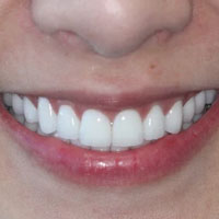 Zoom Teeth Whitening